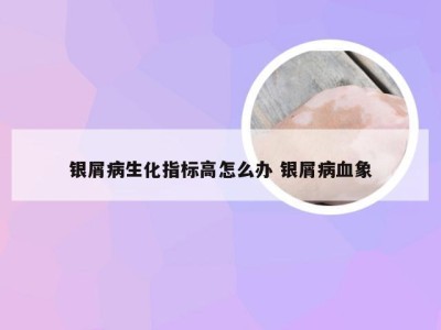 银屑病生化指标高怎么办 银屑病血象