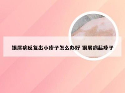 银屑病反复出小疹子怎么办好 银屑病起疹子