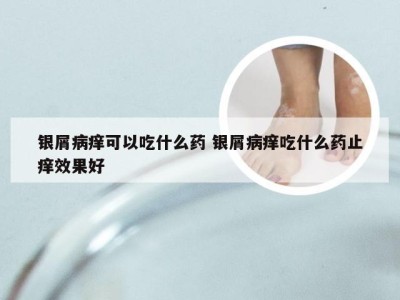 银屑病痒可以吃什么药 银屑病痒吃什么药止痒效果好