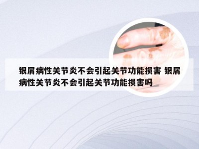 银屑病性关节炎不会引起关节功能损害 银屑病性关节炎不会引起关节功能损害吗