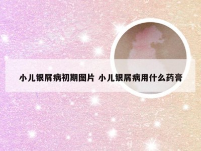 小儿银屑病初期图片 小儿银屑病用什么药膏