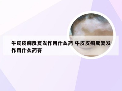 牛皮皮癣反复发作用什么药 牛皮皮癣反复发作用什么药膏