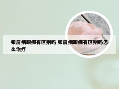 银屑病跟癣有区别吗 银屑病跟癣有区别吗怎么治疗