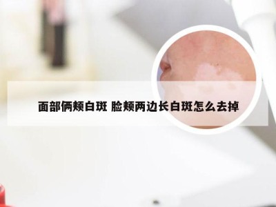 面部俩颊白斑 脸颊两边长白斑怎么去掉