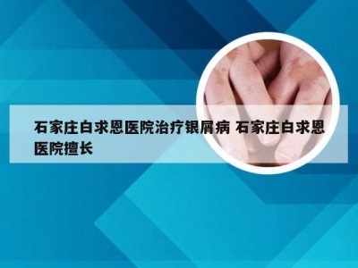 石家庄白求恩医院治疗银屑病 石家庄白求恩医院擅长