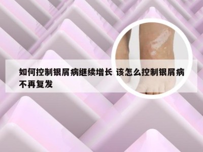 如何控制银屑病继续增长 该怎么控制银屑病不再复发