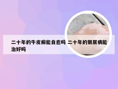 二十年的牛皮癣能自愈吗 二十年的银屑病能治好吗