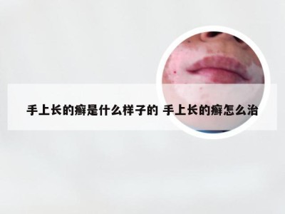 手上长的癣是什么样子的 手上长的癣怎么治