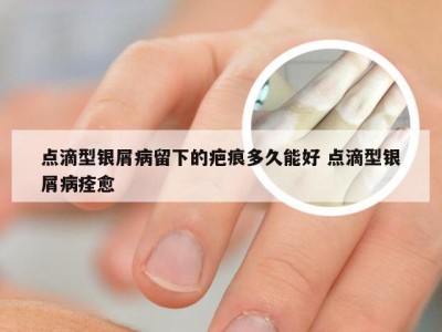 点滴型银屑病留下的疤痕多久能好 点滴型银屑病痊愈