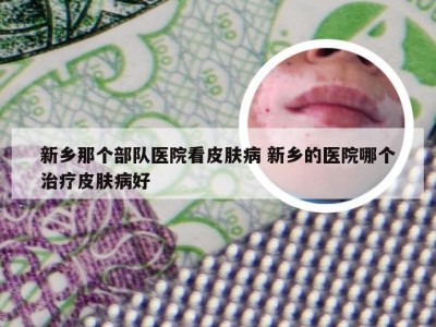 新乡那个部队医院看皮肤病 新乡的医院哪个治疗皮肤病好