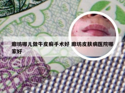 廊坊哪儿做牛皮癣手术好 廊坊皮肤病医院哪家好