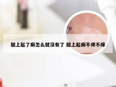 腿上起了癣怎么就没有了 腿上起癣不疼不痒