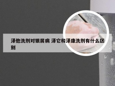 泽他洗剂对银屑病 泽它和泽康洗剂有什么区别