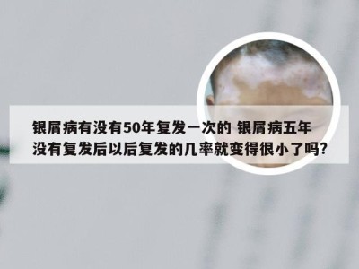 银屑病有没有50年复发一次的 银屑病五年没有复发后以后复发的几率就变得很小了吗?