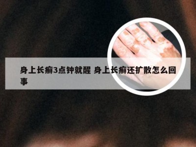 身上长癣3点钟就醒 身上长癣还扩散怎么回事