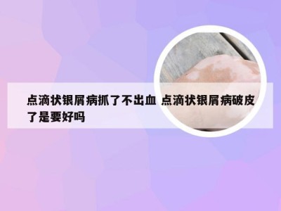 点滴状银屑病抓了不出血 点滴状银屑病破皮了是要好吗