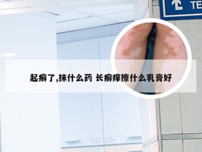 起癣了,抹什么药 长癣痒擦什么乳膏好