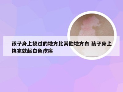 孩子身上挠过的地方比其他地方白 孩子身上挠完就起白色疙瘩