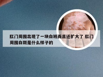 肛门周围出现了一块白班而且还扩大了 肛门周围白斑是什么样子的