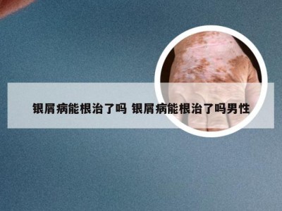 银屑病能根治了吗 银屑病能根治了吗男性