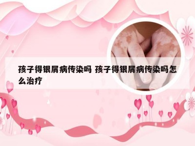 孩子得银屑病传染吗 孩子得银屑病传染吗怎么治疗