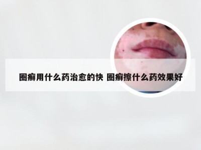 圈癣用什么药治愈的快 圈癣擦什么药效果好